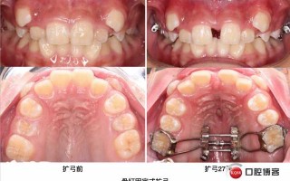 多曲方丝弓，那个被叫做“妙”技术的正畸利器