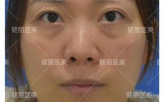 告别显老眼袋，这些不开刀的新技术让你重拾青春眼神